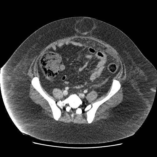 Bowel and splenic infarcts in acute lymphocytic leukemia (Radiopaedia 61055-68915 A 96).jpg