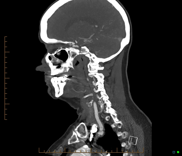 Brachiocephalic trunk stenosis (Radiopaedia 87242-103519 C 41).jpg