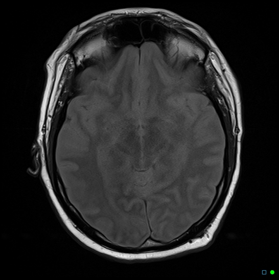 File:Brain death on MRI and CT angiography (Radiopaedia 42560-45689 Axial FLAIR 8).jpg