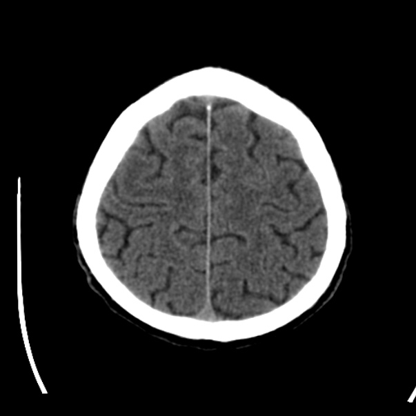 Brain metastases from lung cancer (Radiopaedia 24480-24781 Axial non-contrast 41).jpg