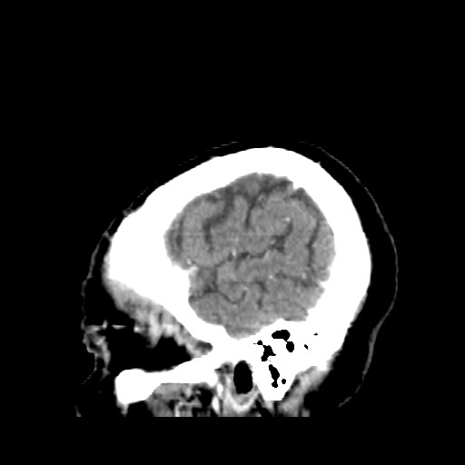 Brain metastasis (Radiopaedia 42617-45760 D 2).jpg