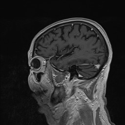 Brain metastasis (Radiopaedia 42617-45761 Sagittal T1 C+ 75).jpg