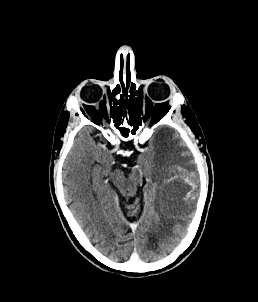 Brain metastasis (large cystic mass) (Radiopaedia 47497-52106 Axial C+ 27).png