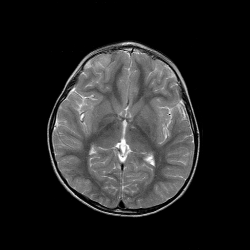 File:Brainstem ganglioglioma (Radiopaedia 10763-11224 Axial T2 10).jpg
