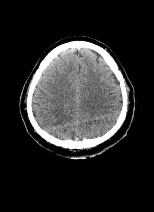 Brainstem hemorrhage (Radiopaedia 81294-94976 Axial non-contrast 20).jpg