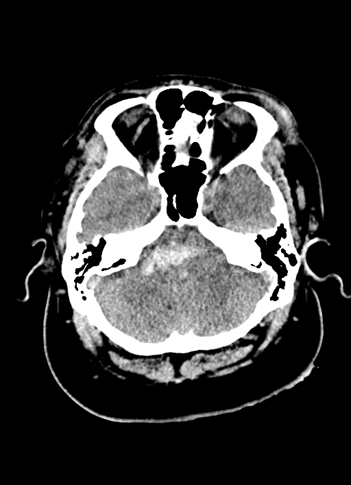 Brainstem hemorrhage (Radiopaedia 81294-94976 Axial non-contrast 47).jpg