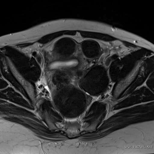 File:Broad ligament fibroid (Radiopaedia 49135-54241 Axial T2 16).jpg