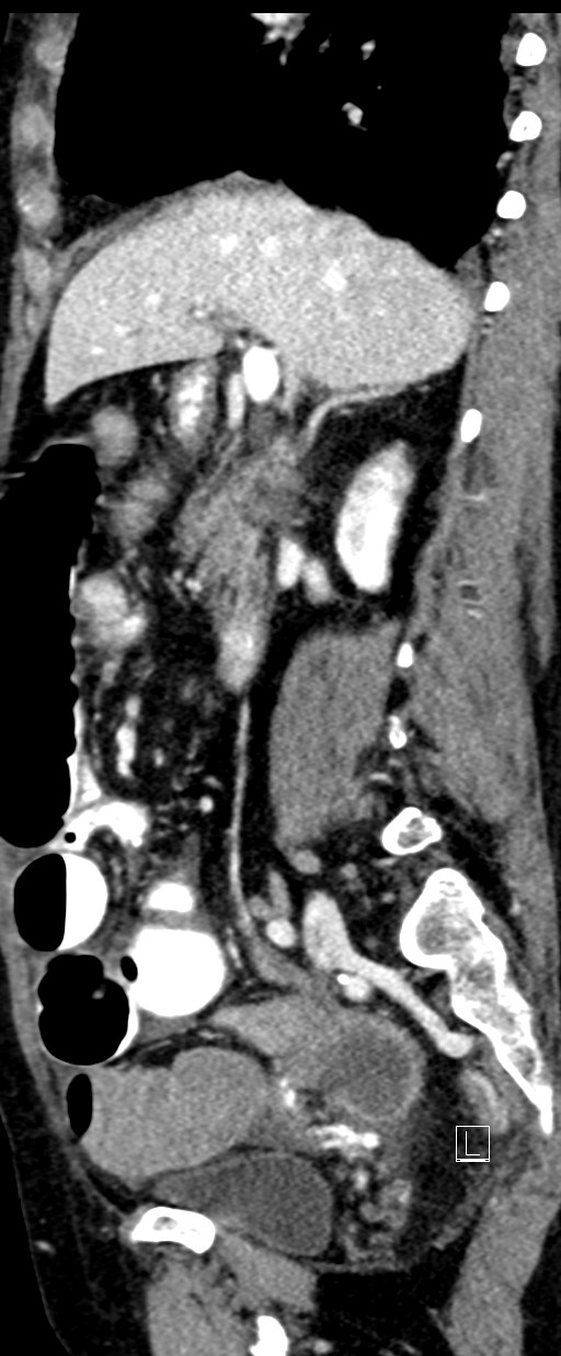 Broad ligament hernia (Radiopaedia 84802-100276 C 49).jpg