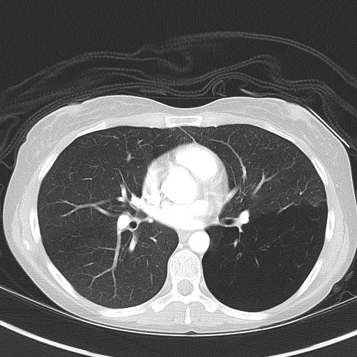 Bronchial atresia (Radiopaedia 73677-84470 Axial lung window 33).jpg