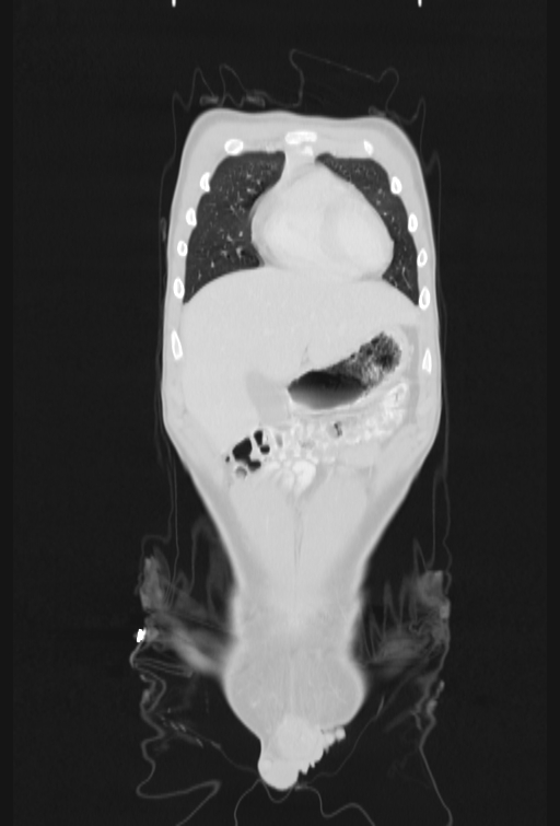Bronchial carcinoid tumor (Radiopaedia 57187-64090 Coronal lung window 12).jpg
