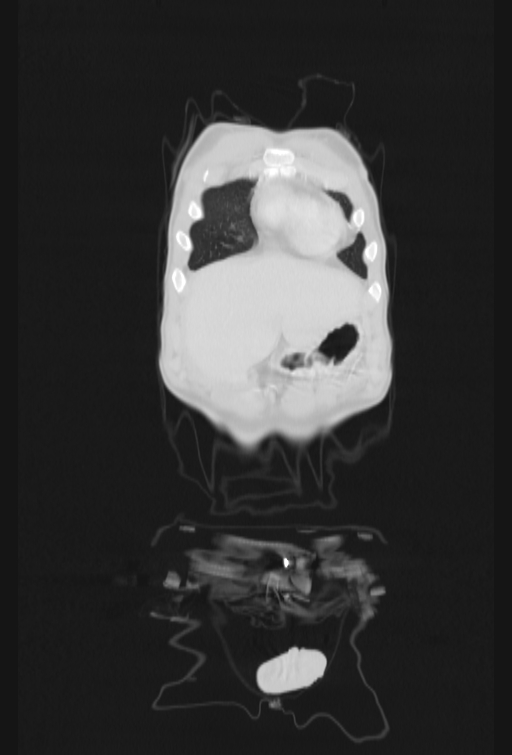 Bronchial carcinoid tumor (Radiopaedia 57187-64090 Coronal lung window 4).jpg