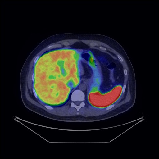 File:Bronchial carcinoid tumor (Radiopaedia 67377-76765 68Ga-DOTATATE PET-CT 40).jpg