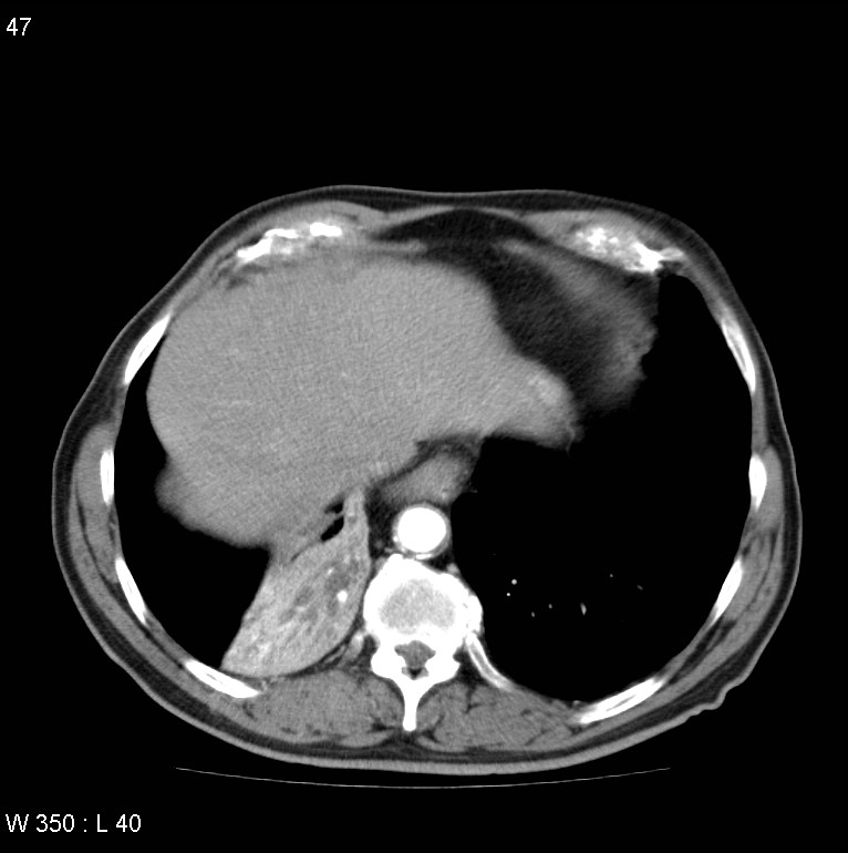 Bronchial carcinoid tumor with right lower lobe collapse (Radiopaedia 29060-29422 A 46).jpg
