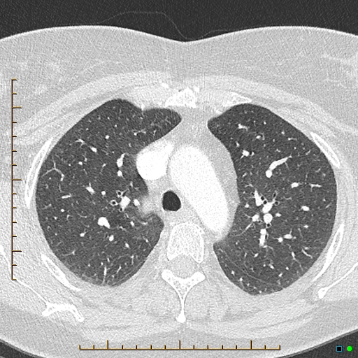 Bronchial diverticula (Radiopaedia 79512-92676 Axial lung window 52).jpg
