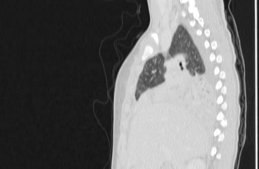 Bronchial mucoepidermoid carcinoma (Radiopaedia 57023-63895 Sagittal lung window 46).jpg