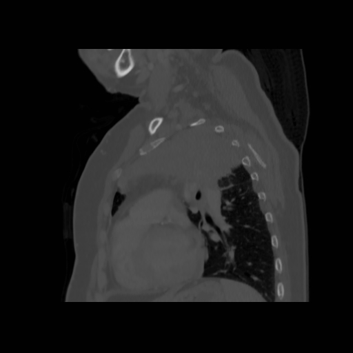 Bronchogenic carcinoma (Radiopaedia 73497-84262 Sagittal bone window 106).jpg
