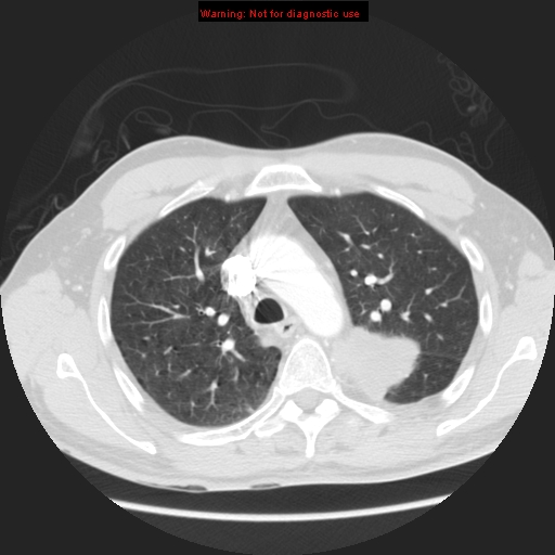File:Bronchogenic carcinoma brain metastasis (Radiopaedia 9286-105832 Axial lung window 17).jpg