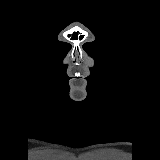 Buccal fat pad arteriovenous malformation (Radiopaedia 70936-81144 B 2).jpg
