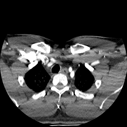 Buccal fat pad arteriovenous malformation (Radiopaedia 70936-81144 D 27).jpg