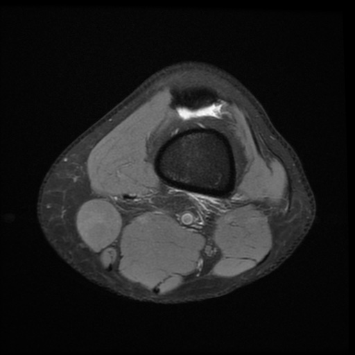File:Bucket-handle meniscus tear (Radiopaedia 65700-74809 Axial PD fat sat 4).jpg