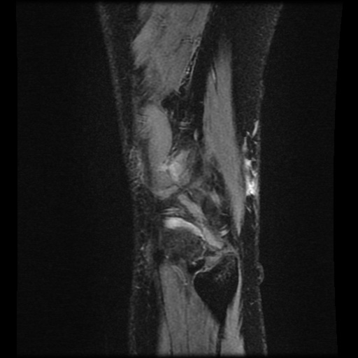 File:Bucket handle meniscus tear (Radiopaedia 56916-63751 H 3).jpg