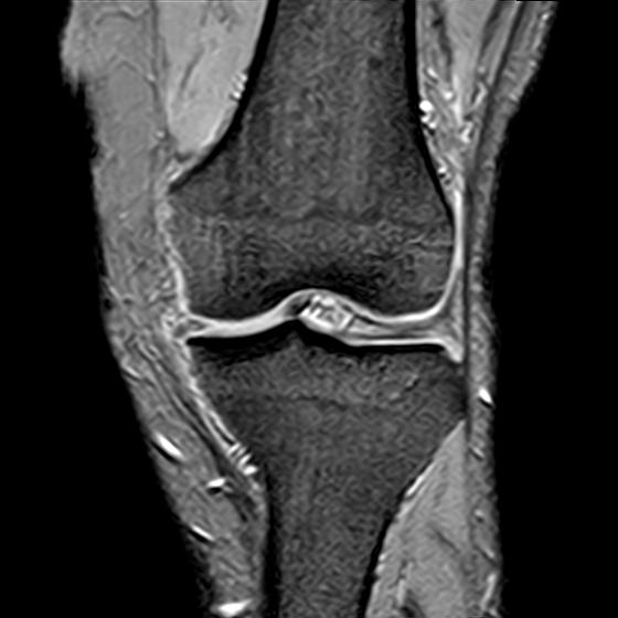 File:Bucket handle tear - medial meniscus (Radiopaedia 29250-29664 B 7).jpg