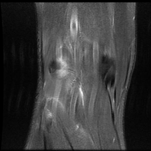 File:Bucket handle tear - medial meniscus (Radiopaedia 69245-79026 Coronal PD fat sat 18).jpg