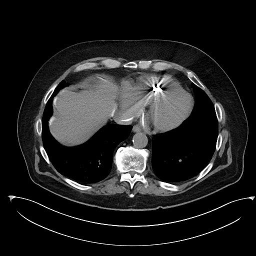 File:Buried bumper syndrome - gastrostomy tube (Radiopaedia 63843-72577 Axial Inject 7).jpg