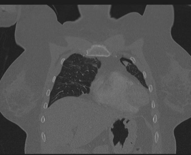 Burst fracture - thoracic spine (Radiopaedia 30238-30865 Coronal bone window 42).jpg