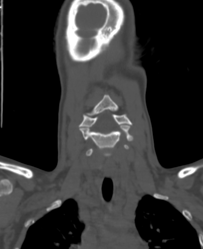 Butterfly vertebra (Radiopaedia 77903-90209 Coronal bone window 8).jpg