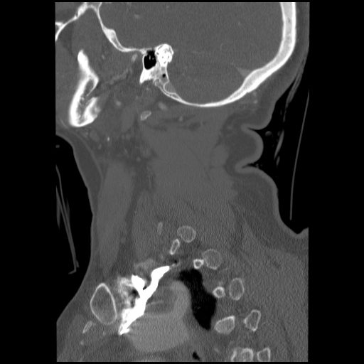 File:C1 anterior arch (plough) fracture - type 1 (Radiopaedia 76181-87720 Sagittal bone window 29).jpg
