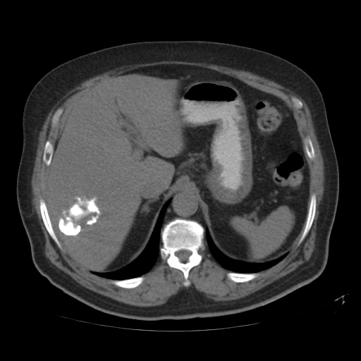 File:Calcified hepatic hydatid cyst (Radiopaedia 18907-18853 Axial non-contrast 12).jpg