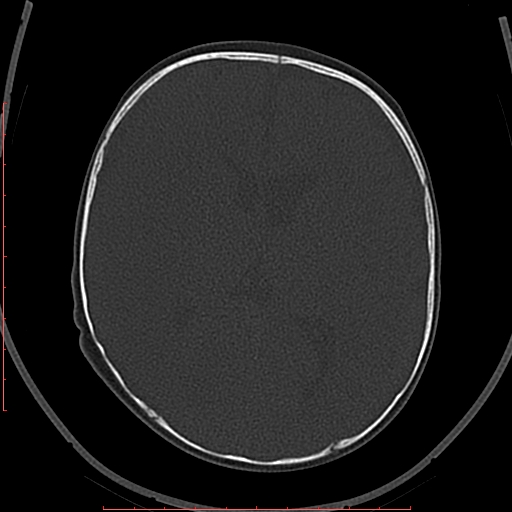 Calcified middle cerebral artery embolism (Radiopaedia 78949-91860 Axial bone window 35).jpg