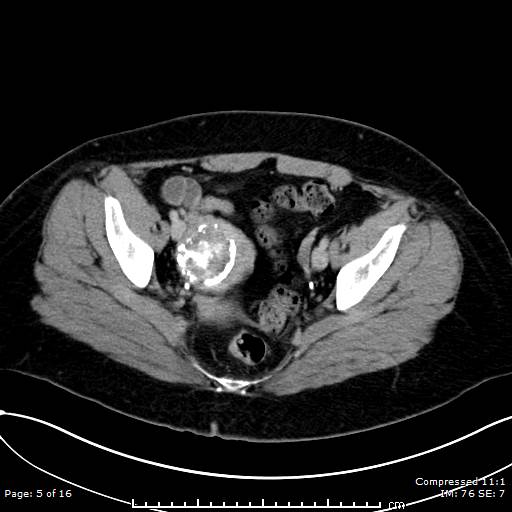 File:Calcified uterine fibroid (Radiopaedia 56077-62759 Axial C+ delayed 5).jpg
