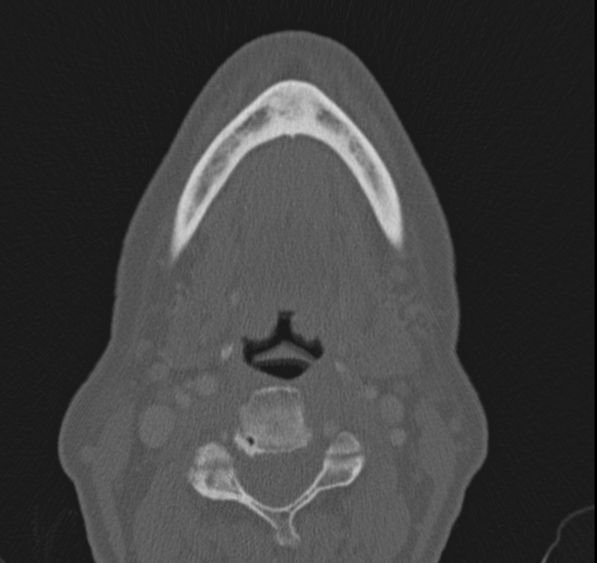 Caldwell-Luc operation (Radiopaedia 52329-58225 Axial bone window 67).jpg
