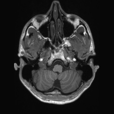 Callosal dysgenesis with interhemispheric cyst (Radiopaedia 53355-59335 Axial T1 25).jpg
