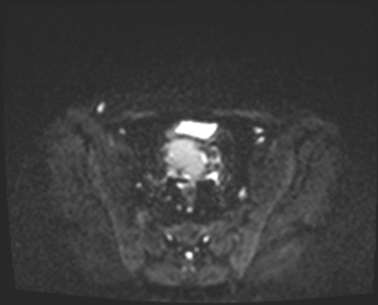 Cancer cervix - stage IIb (Radiopaedia 75411-86615 Axial DWI 21).jpg