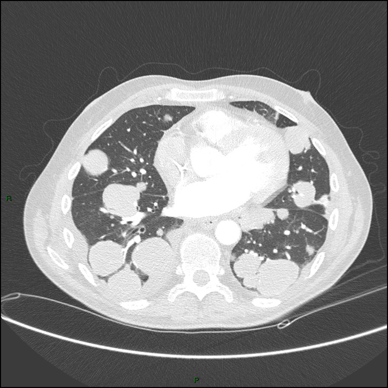 Cannonball metastases (Radiopaedia 82110-96150 Axial lung window 124).jpg