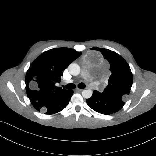 Cannonball metastases - testicular choriocarcinoma (Radiopaedia 84510-99891 B 51).jpg