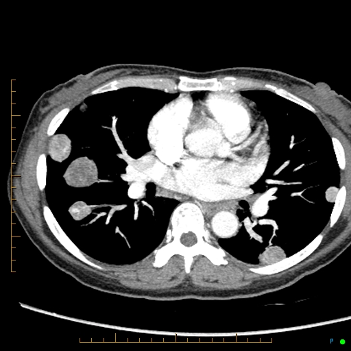 Canonball lung metastasis (Radiopaedia 77634-89837 B 50).jpg