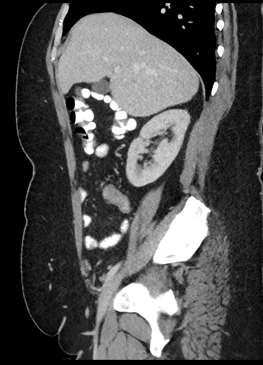Carcinoid tumor - terminal ileum (Radiopaedia 60931-68739 C 70).jpg