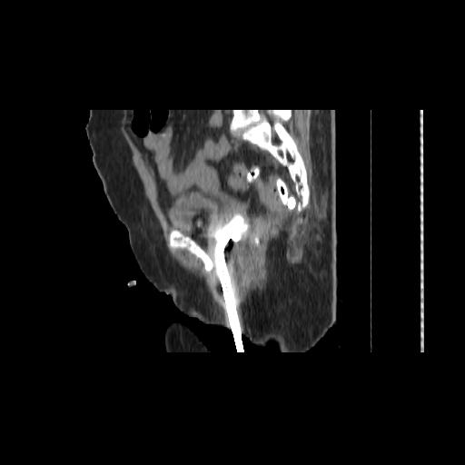 File:Carcinoma cervix- brachytherapy applicator (Radiopaedia 33135-34173 D 108).jpg