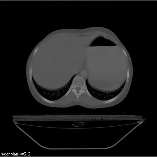 File:Carcinoma of esophagus (Radiopaedia 27356-27550 Axial bone window 6).jpg