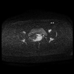 Carcinoma of the cervix (Radiopaedia 89018-105858 Axial DWI 72).jpg