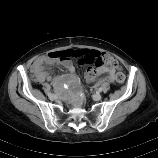 Carcinosarcoma (Radiopaedia 70401-80503 A 48).jpg