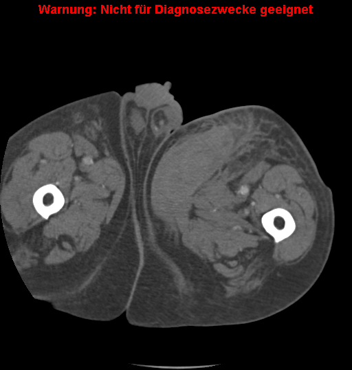 File:Cardiac perforation following transcatheter aortic valve implantation (Radiopaedia 23714-23863 B 30).png