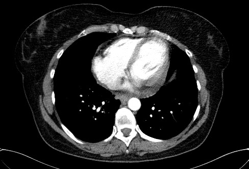 File:Cardiac sarcoidosis (Radiopaedia 74548-85534 A 61).jpg