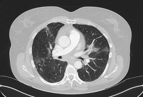 Cardiac sarcoidosis (Radiopaedia 74548-85534 Axial lung window 38).jpg