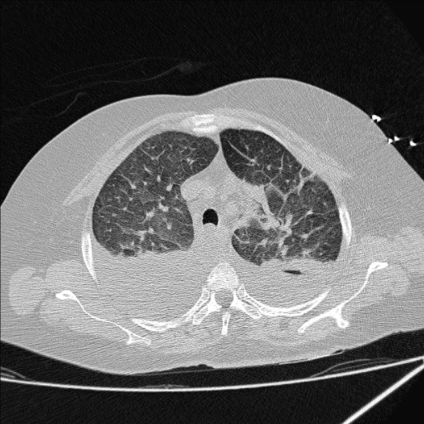 Cardiogenic pulmonary edema (Radiopaedia 29213-29609 Axial lung window 22).jpg