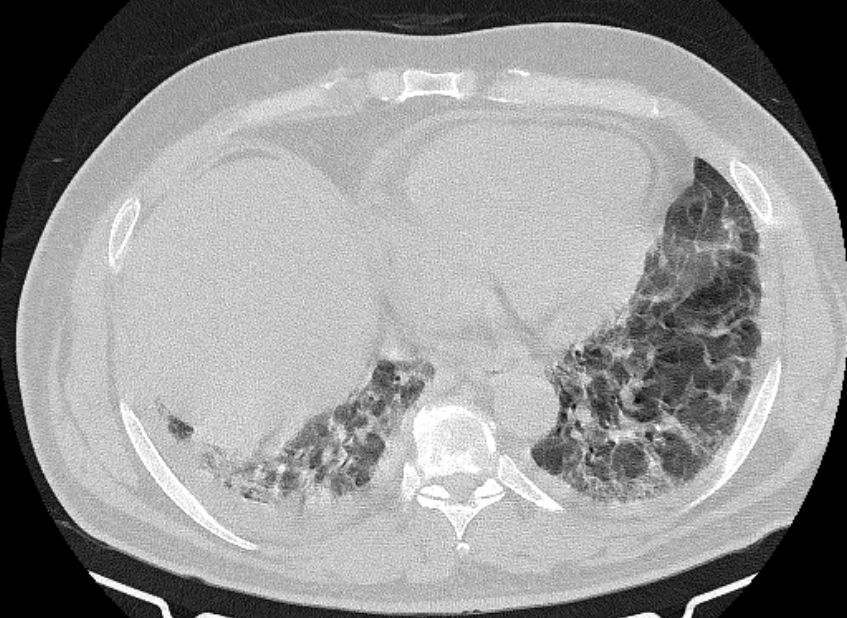 Cardiogenic pulmonary edema (Radiopaedia 68180-77678 Axial lung window 75).jpg
